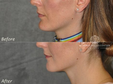 Beverly Hills Center Female Patient Before and After Weekend Necklift