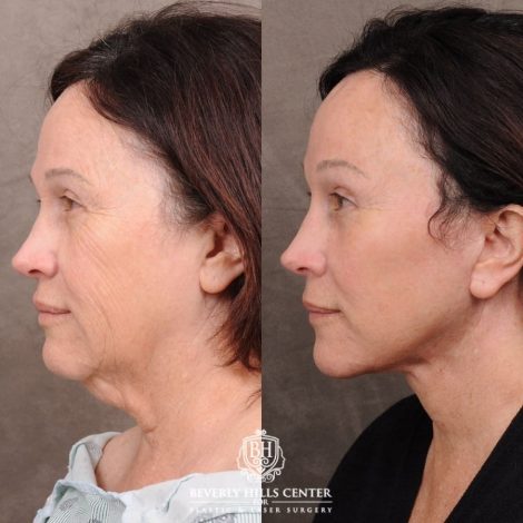 Beverly Hills Center Female Patient Before and After AuraLyft, Temporal Brow Reset, PHAT Face, TCA Peel Under Eyes
