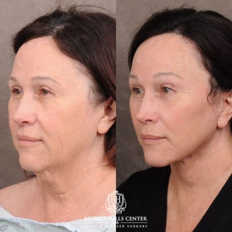 Beverly Hills Center Female Patient Before and After AuraLyft, Temporal Brow Reset, PHAT Face, TCA Peel Under Eyes