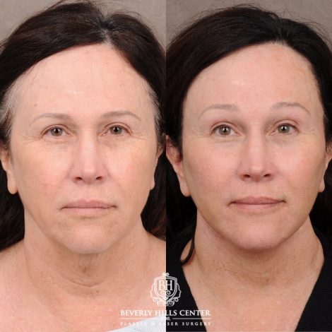 Beverly Hills Center Female Patient Before and After AuraLyft, Temporal Brow Reset, PHAT Face, TCA Peel Under Eyes