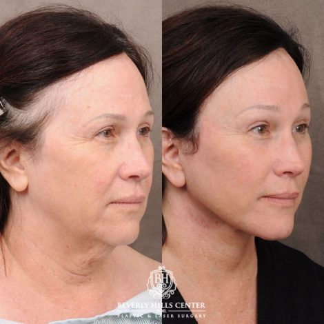 Beverly Hills Center Female Patient Before and After AuraLyft, Temporal Brow Reset, PHAT Face, TCA Peel Under Eyes