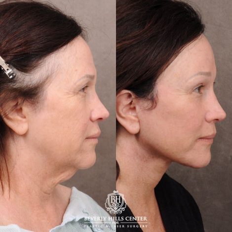 Beverly Hills Center Female Patient Before and After AuraLyft, Temporal Brow Reset, PHAT Face, TCA Peel Under Eyes