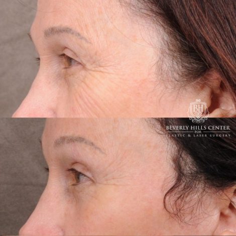 Beverly Hills Center Female Patient Before and After AuraLyft, Temporal Brow Reset, PHAT Face, TCA Peel Under Eyes