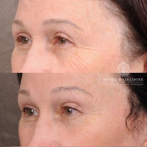 Beverly Hills Center Female Patient Before and After AuraLyft, Temporal Brow Reset, PHAT Face, TCA Peel Under Eyes