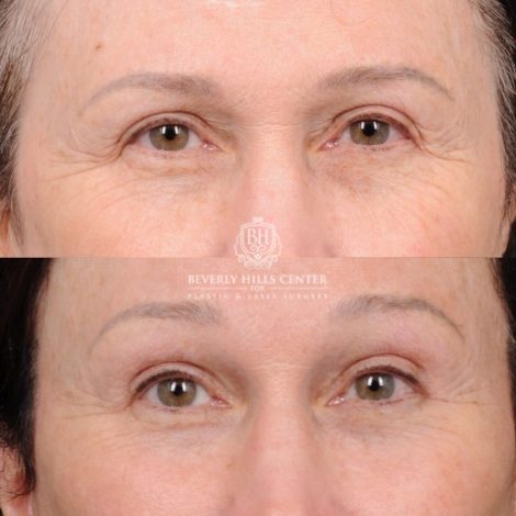Beverly Hills Center Female Patient Before and After AuraLyft, Temporal Brow Reset, PHAT Face, TCA Peel Under Eyes
