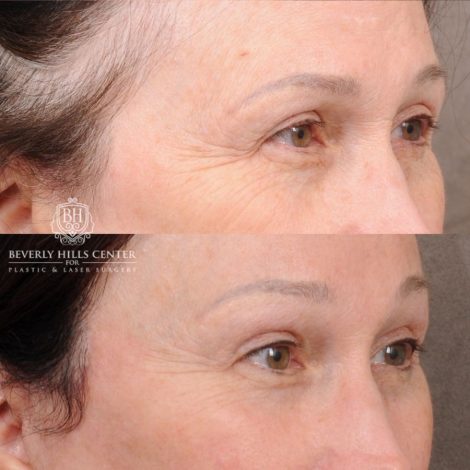 Beverly Hills Center Female Patient Before and After AuraLyft, Temporal Brow Reset, PHAT Face, TCA Peel Under Eyes