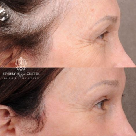 Beverly Hills Center Female Patient Before and After AuraLyft, Temporal Brow Reset, PHAT Face, TCA Peel Under Eyes