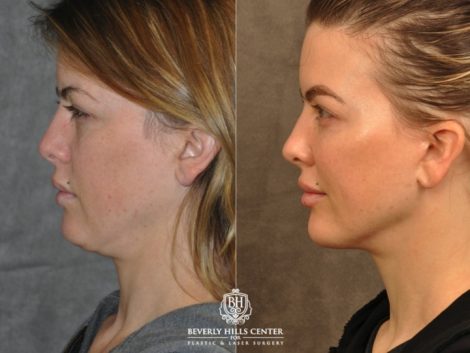 Beverly Hills Center Female Patient Before and After Weekend Necklift