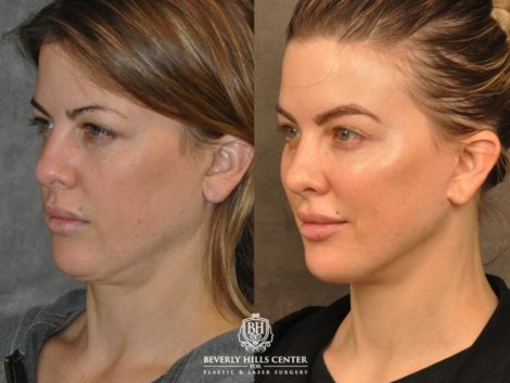 Beverly Hills Center Female Patient Before and After Weekend Necklift