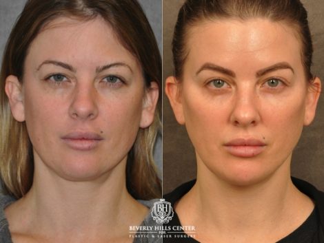 Beverly Hills Center Female Patient Before and After Weekend Necklift