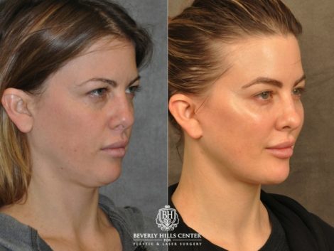 Beverly Hills Center Female Patient Before and After Weekend Necklift