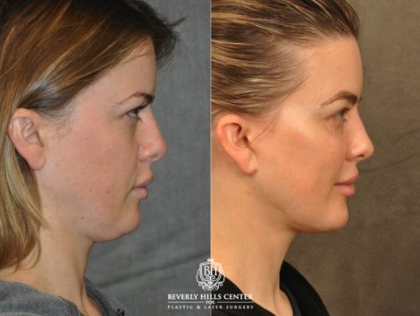 Beverly Hills Center Female Patient Before and After Weekend Necklift