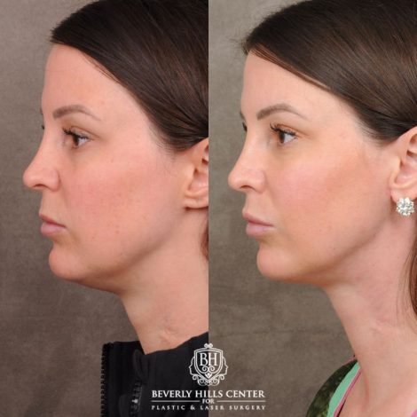 Beverly Hills Center Female Patient Before and After Cupid Lift Lip Lift with Corners & Weekend Neck Lift