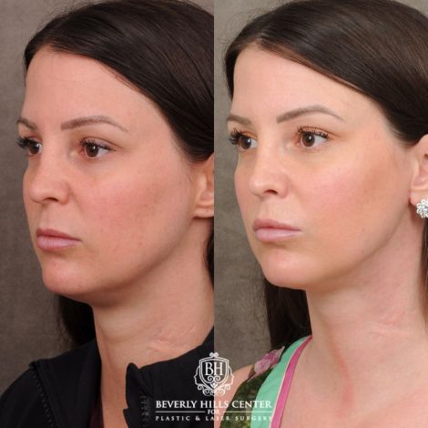 Beverly Hills Center Female Patient Before and After Cupid Lift Lip Lift with Corners & Weekend Neck Lift