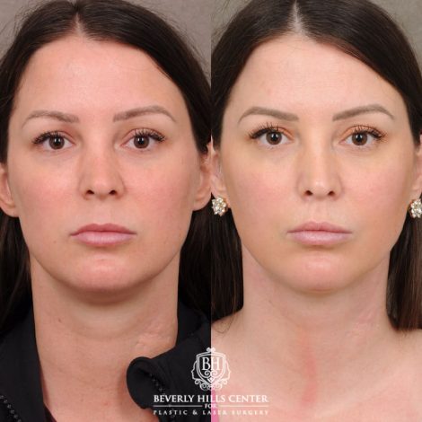 Beverly Hills Center Female Patient Before and After Cupid Lift Lip Lift with Corners & Weekend Neck Lift