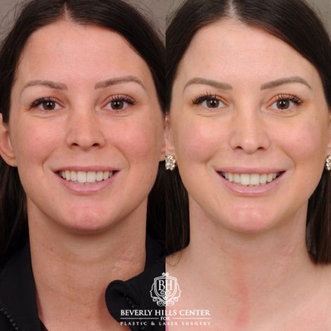 Beverly Hills Center Female Patient Before and After Cupid Lift Lip Lift with Corners & Weekend Neck Lift