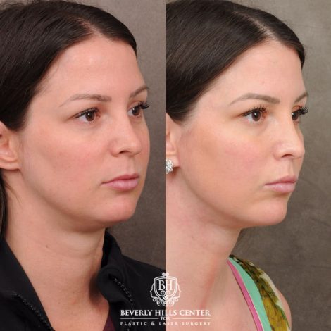 Beverly Hills Center Female Patient Before and After Cupid Lift Lip Lift with Corners & Weekend Neck Lift