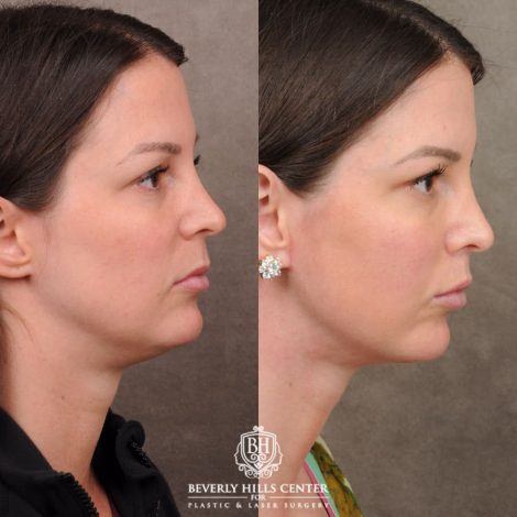 Beverly Hills Center Female Patient Before and After Cupid Lift Lip Lift with Corners & Weekend Neck Lift