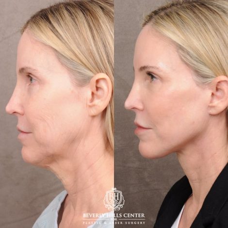 Beverly Hills Center Female Patient Before and After AuraLyft™, Fat Grafting