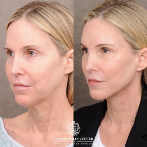 Beverly Hills Center Female Patient Before and After AuraLyft™, Fat Grafting