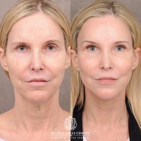Beverly Hills Center Female Patient Before and After AuraLyft™, Fat Grafting