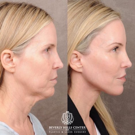 Beverly Hills Center Female Patient Before and After AuraLyft™, Fat Grafting