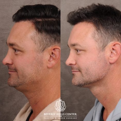 Beverly Hills Center Male Patient Before and After Weekend Necklift