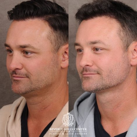 Beverly Hills Center Male Patient Before and After Weekend Necklift