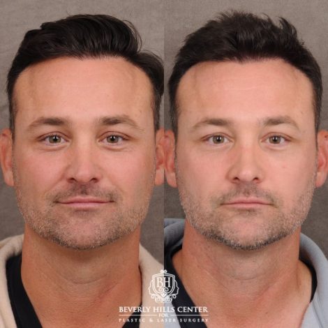 Beverly Hills Center Male Patient Before and After Weekend Necklift