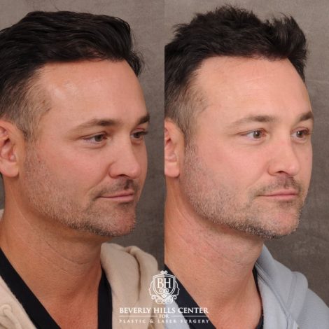 Beverly Hills Center Male Patient Before and After Weekend Necklift