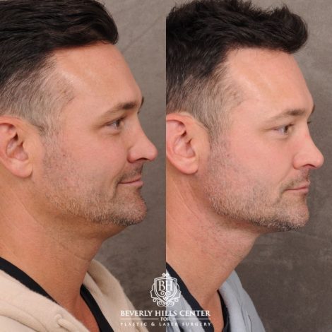 Beverly Hills Center Male Patient Before and After Weekend Necklift