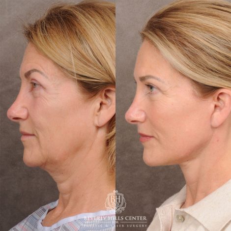 AuraLyft™, Temporal Brow Reset, Upper & Lower Blepharoplasty - Left Side