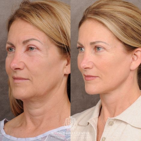 AuraLyft™, Temporal Brow Reset, Upper & Lower Blepharoplasty - Left Side