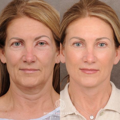 Beverly Hills Center Female Patient Before and After AuraLyft™, Temporal Brow Reset, Upper & Lower Blepharoplasty - front
