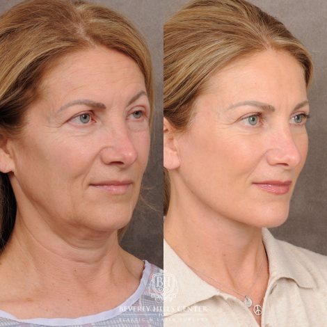 AuraLyft™, Temporal Brow Reset, Upper & Lower Blepharoplasty - Right Side