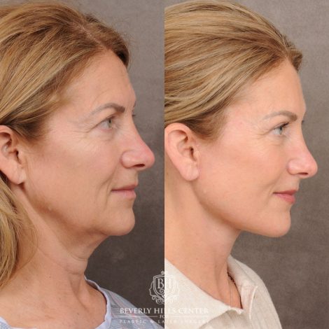 AuraLyft™, Temporal Brow Reset, Upper & Lower Blepharoplasty - Right Side