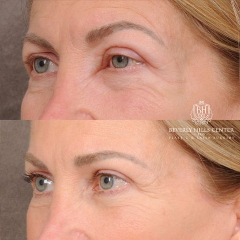 Beverly Hills Center Female Patient Before and After AuraLyft™, Temporal Brow Reset, Upper & Lower Blepharoplasty