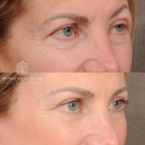Beverly Hills Center Female Patient Before and After AuraLyft™, Temporal Brow Reset, Upper & Lower Blepharoplasty