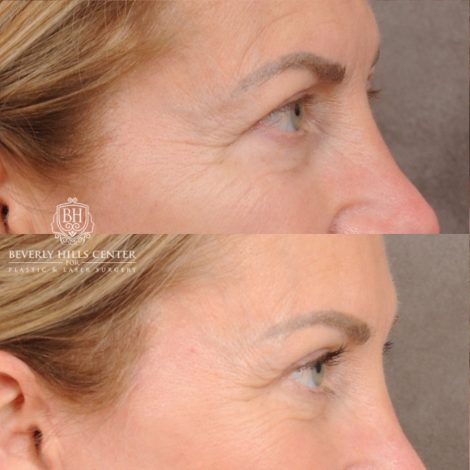 Beverly Hills Center Female Patient Before and After AuraLyft™, Temporal Brow Reset, Upper & Lower Blepharoplasty