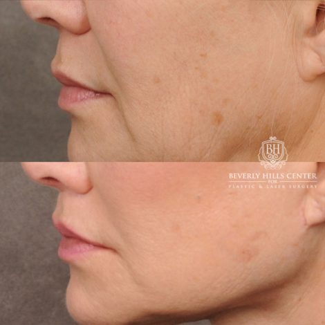 AuraLyft™, Tempral Brow Reset, Cupid Lift®, TCA Peel (Eyes)