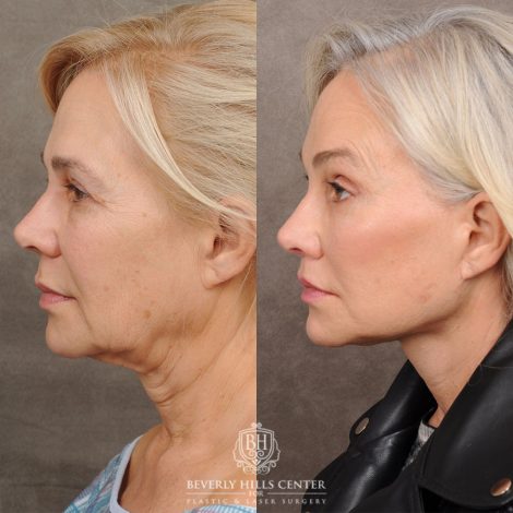 AuraLyft™, Tempral Brow Reset, Cupid Lift®, TCA Peel (Eyes)