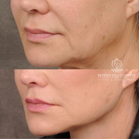 AuraLyft™, Tempral Brow Reset, Cupid Lift®, TCA Peel (Eyes)