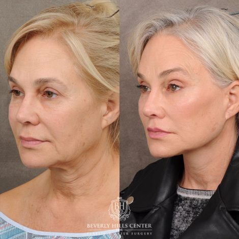 AuraLyft™, Tempral Brow Reset, Cupid Lift®, TCA Peel (Eyes)