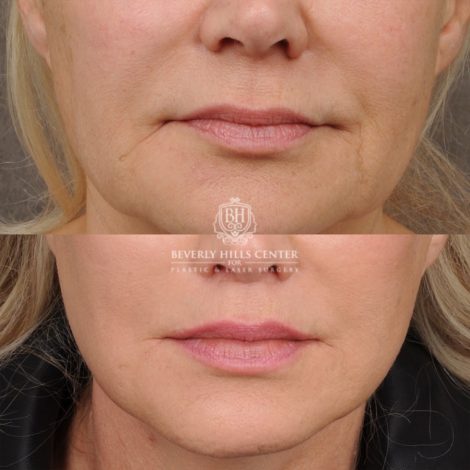 AuraLyft™, Tempral Brow Reset, Cupid Lift®, TCA Peel (Eyes)