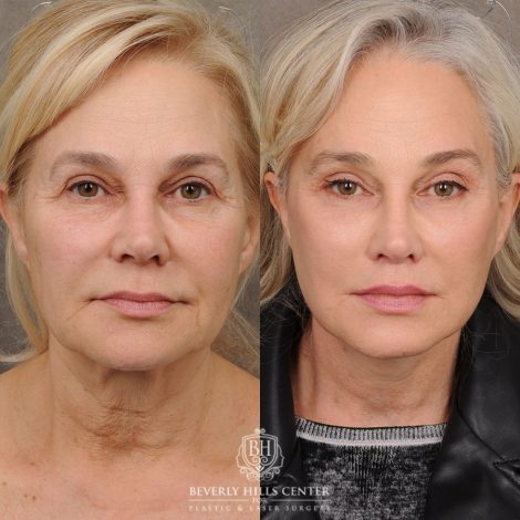 AuraLyft™, Tempral Brow Reset, Cupid Lift®, TCA Peel (Eyes)