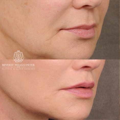 AuraLyft™, Tempral Brow Reset, Cupid Lift®, TCA Peel (Eyes)