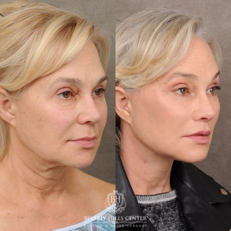 AuraLyft™, Tempral Brow Reset, Cupid Lift®, TCA Peel (Eyes)