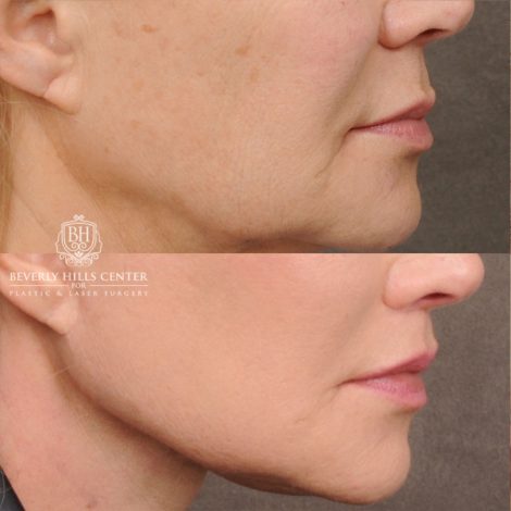 AuraLyft™, Tempral Brow Reset, Cupid Lift®, TCA Peel (Eyes)