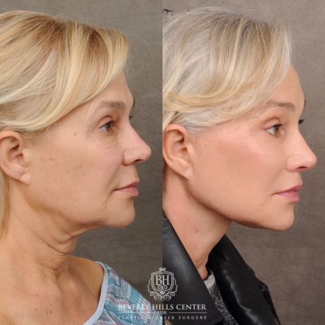 AuraLyft™, Tempral Brow Reset, Cupid Lift®, TCA Peel (Eyes)