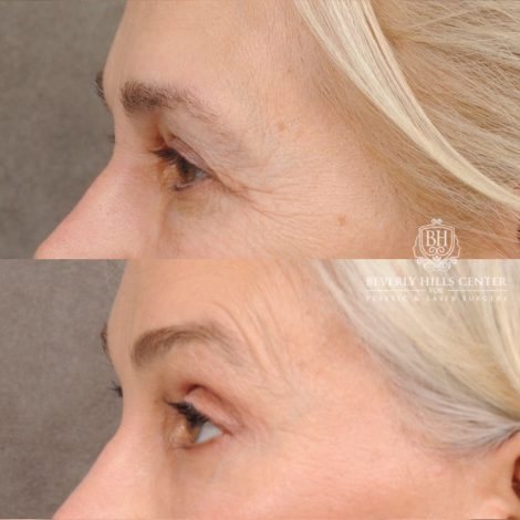 AuraLyft™, Tempral Brow Reset, Cupid Lift®, TCA Peel (Eyes)